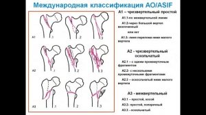 Переломы проксимального отдела бедренной кости. Лекция.