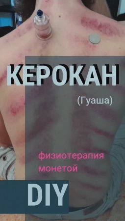Керокан или Гуа ша - народная тпадиционная физиотерапевтическая процедура из Азии