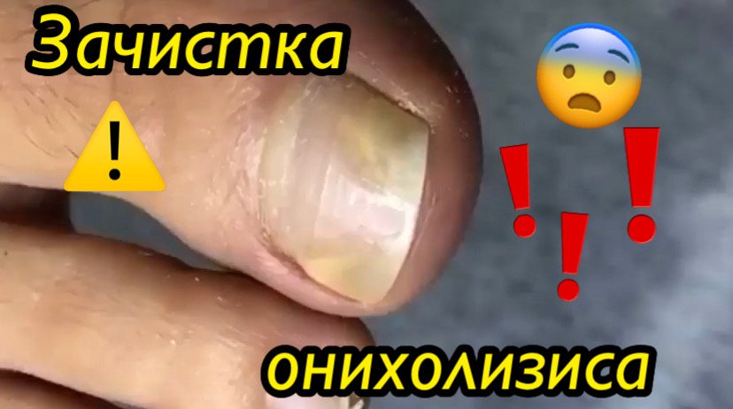 Зачистка онихолизиса?⚠️?