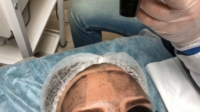 Лазерный карбоновый пилинг. Центр косметологии NO TATTOO