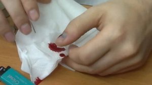 Удаление подногтевой гиматомы