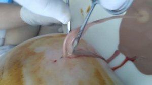 Popping Huge Pimples,Cysts,Boils,Zits !!! TOP 10 .Выдавливание прыщей.