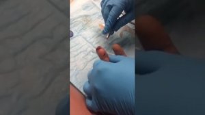 Глубокий порез пальца.. Хирургия