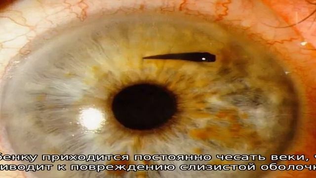 Почему ребенок чешет глаза и нос руками, возможные причины смотреть онлайн