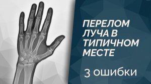 3 ошибки врача и пациента - Реабилитация луча в типичном месте