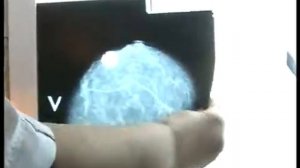 Рак кожи лидирует среди онкопатологий в Красном Луче.