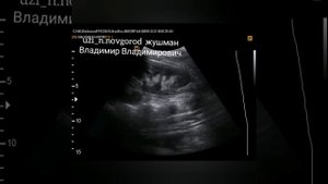 Стент мочеточника УЗИ