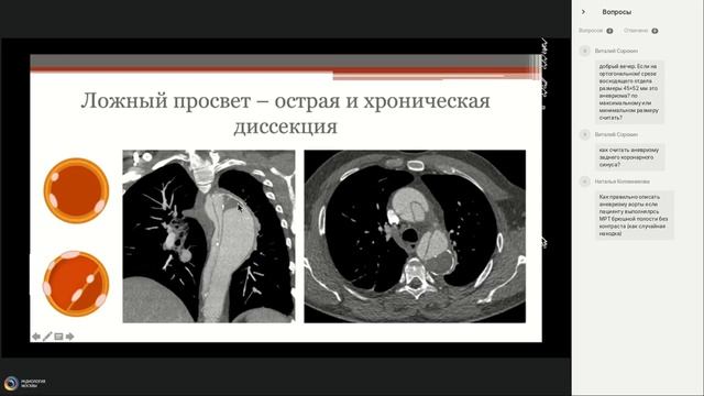 КТ аортография