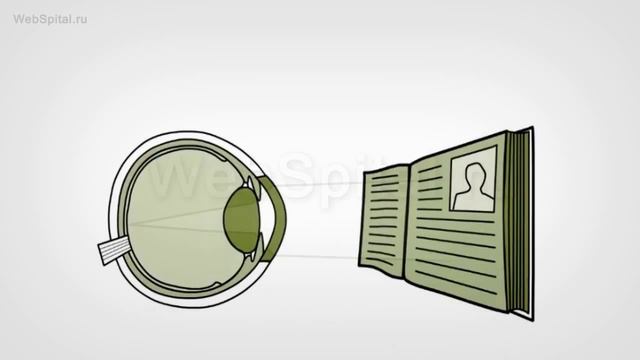 ЛАСЕК, эпи-ЛАСИК. Лазерная коррекция астигматизма смотреть онлайн