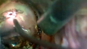 Лазерная вапоризация при дисплазии шейки матки