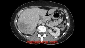 Опухоль толстой кишки.  Метастаз в печени