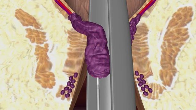 LHP Animation By Biolitec