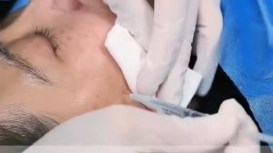 филлер полимолочной кислоты Reborn PLLA Filler