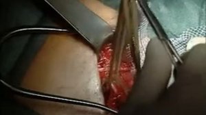 Пластика грыжи по Лихтенштейну