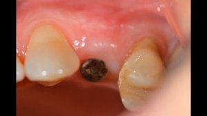 Одномоментная имплантация с костной пластикой по методике IDR