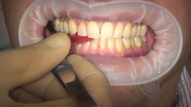 Артикуляционная фольга Arti Fol® 8µ смотреть онлайн