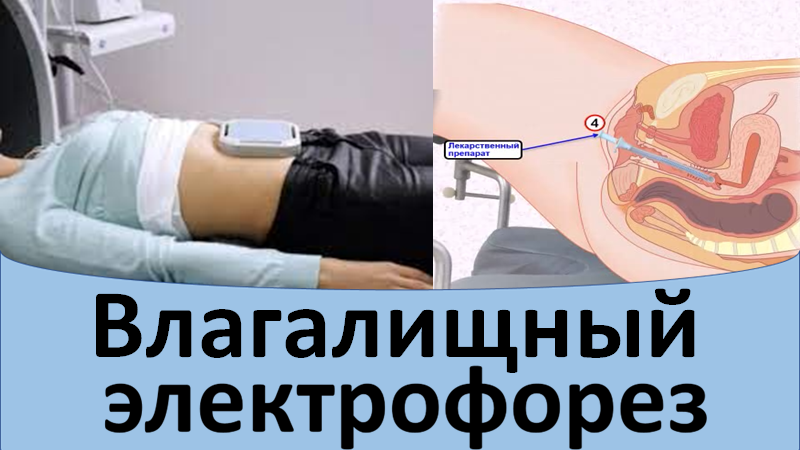 Влагалищный электрофорез
