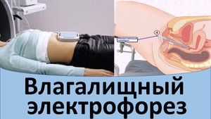 Влагалищный электрофорез