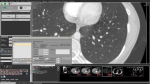 Оценка поражения лёгких по КТ изображениям