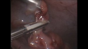 Безлигатурная лапароскопическая аппендэктомия у детей