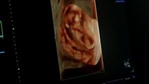 1 Скрининг при беременности.mp4