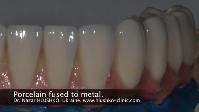 Lower jaw implant treatment. Dr. Nazar HLUSHKO. смотреть онлайн