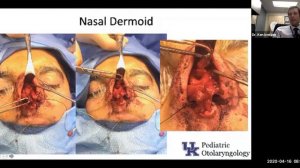 When You Think It's a Booger But It'S NOT: Congenital Nasal Airway Disorders - Dr. Ken Iverson