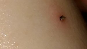 Как мы вытащили клеща ниткой. how to remove a tick. cómo tirar de un ácaro