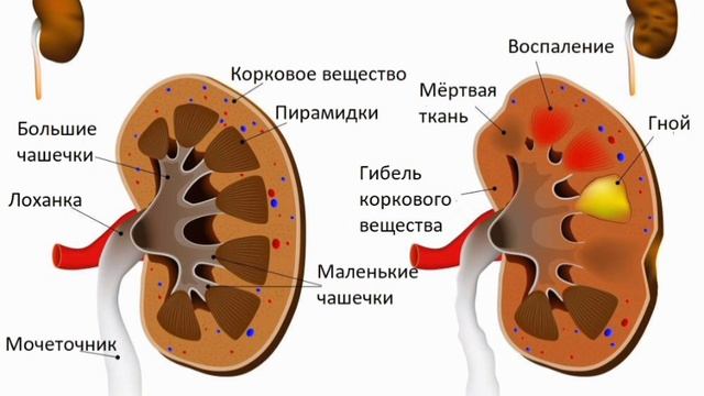 Пиелонефрит : особенности течения и лечение