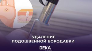 Удаление подошвенной бородавки | MOTUS AX с технологией AY