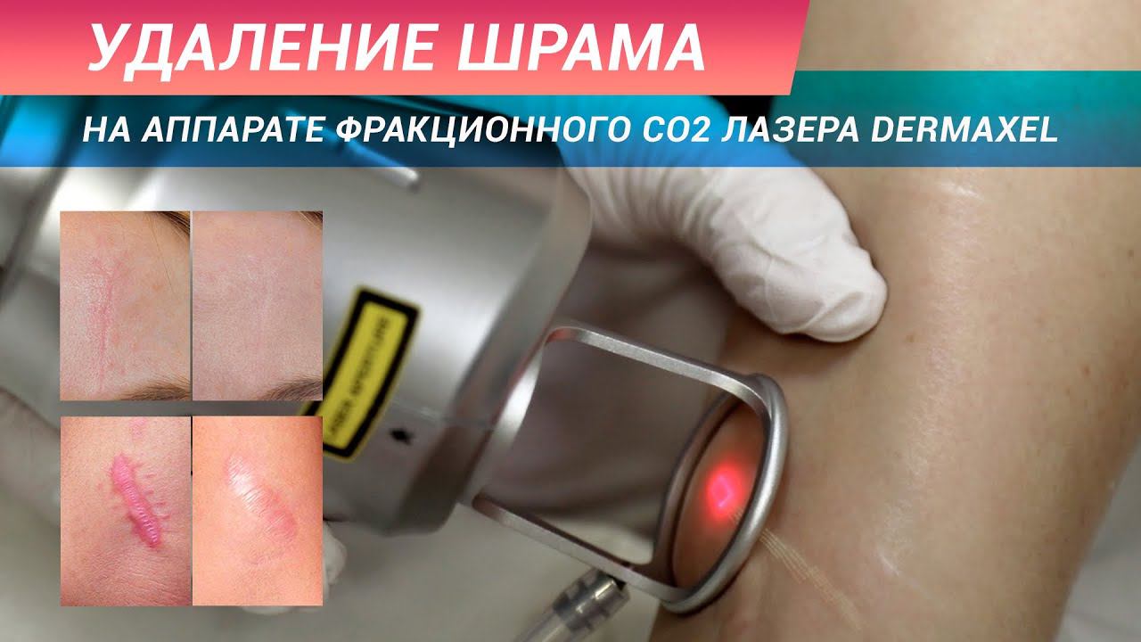 Лазерное удаление шрама СО2 лазером DERMAXEL