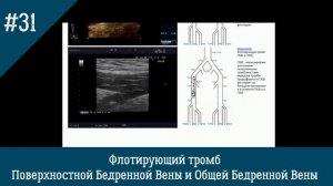 УЗИ вен. Флотирующий тромб Поверхностной Бедренной Вены и Общей Бедренной Вены
