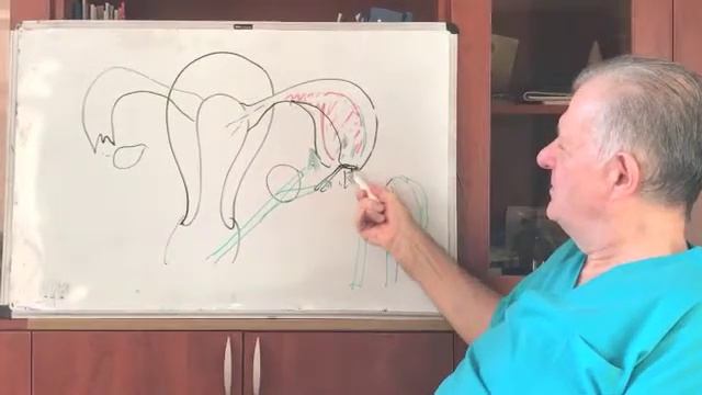 Сальпингоскопия. устранение стеноза остиума маточной трубы. фертилоскопия.Гидролапароскопия. смотреть онлайн