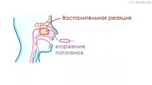 Синусит: механизм развития, симптомы, диагностика, лечение - кратко