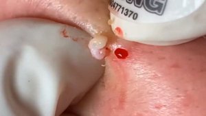 How To Get Rid of Blackheads | Dear  Derm | Well+ Good(Remove blackhead) Spa Part#64