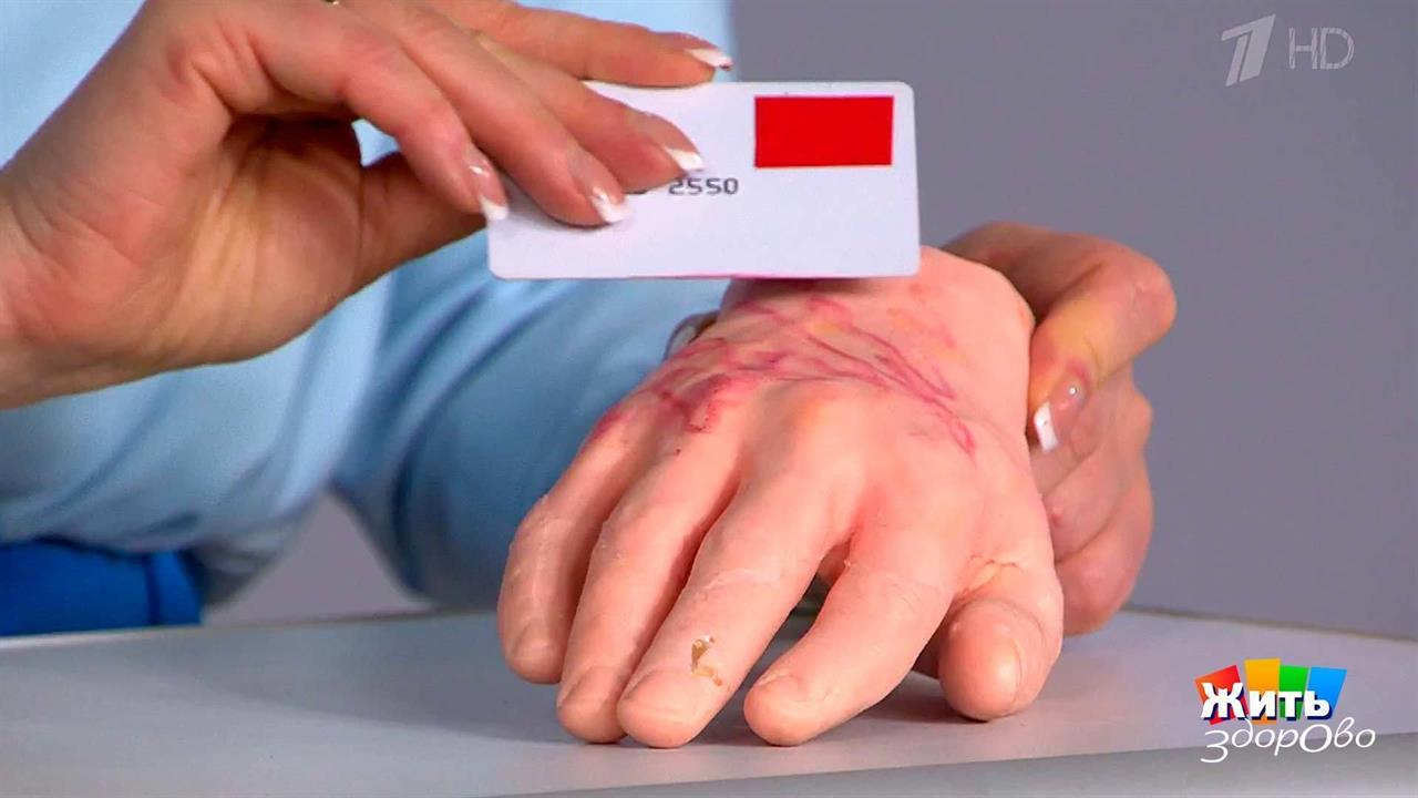 Укус медузы. Как помочь самому себе? Жить здорово! Фрагмент выпуска от 24.05.2017