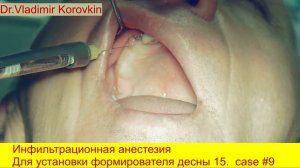 инфильтрационная анестезия для установки формирователя десны 15 . Поиск заглушки инъекцией.