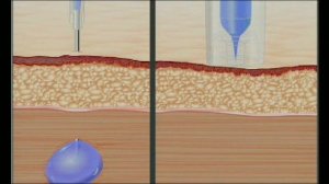 Needle VS Needle Free Injection