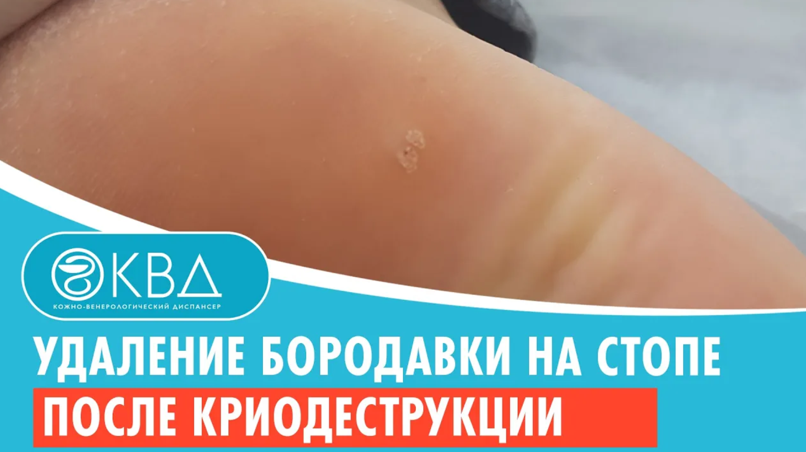 ? Удаление бородавки на стопе после криодеструкции. Клинический случай №980