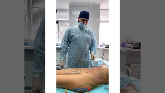 Липоскульптура тела с липофилингом ягодиц смотреть онлайн