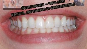 Флегмона – что это такое, лечение и симптомы