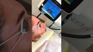 Фотоомоложение на аппарате  Candela Nordlys + плазмотерапия