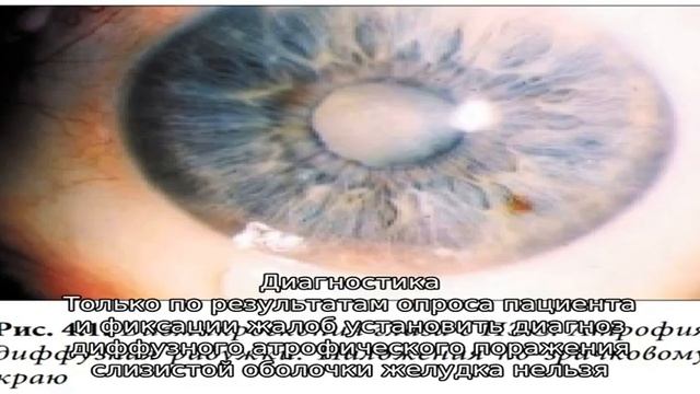 Симптомы и лечение диффузного атрофического гастрита – смотреть онлайн ...