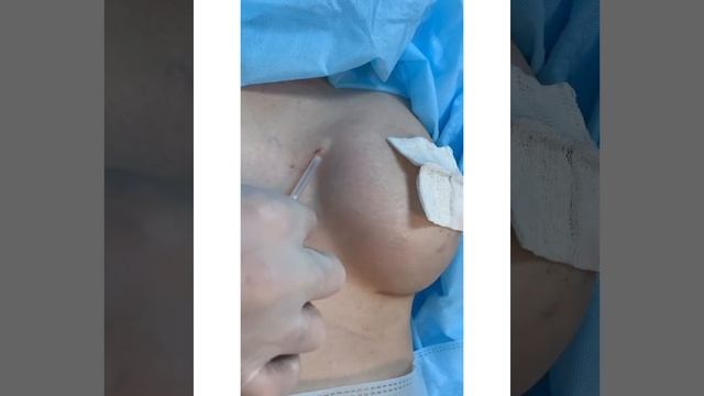 Липофилинг контурированного импланта в процессе смотреть онлайн