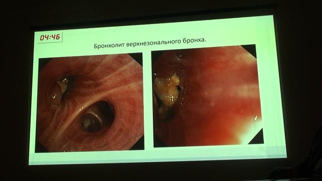 1 Хачатрян Н.Х. Давно аспирированное инородное тело? Экстракция, анализ смотреть онлайн