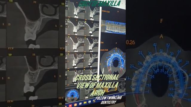 dental radiograph/cbct of maxilla/cross sectional view