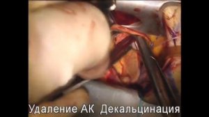 ПРОТЕЗИРОВАНИЕ АОРТАЛЬНОГО КЛАПАНА ИЗ МИНИДОСТУПА