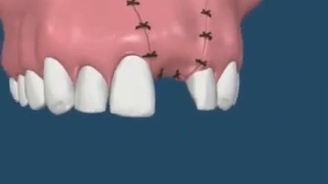Наращивание кости с имплантацией зубов смотреть онлайн