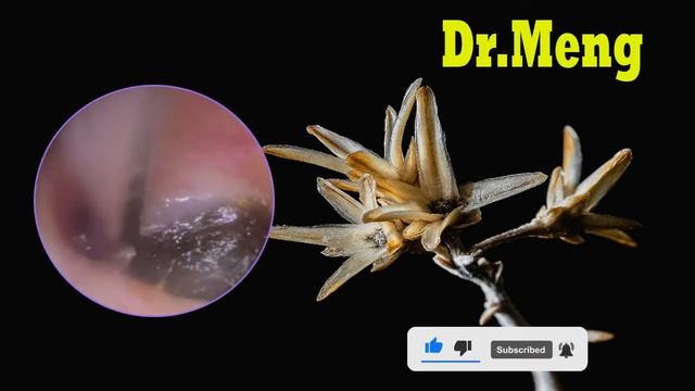 [Чистка ушей]удаление ушной серы|УДАЛЕННОЕ УДАЛЕНИЕ ВОСКА ИЗ НАУШНИЦЫ.VOL.1/CLIPS #4 смотреть онлайн