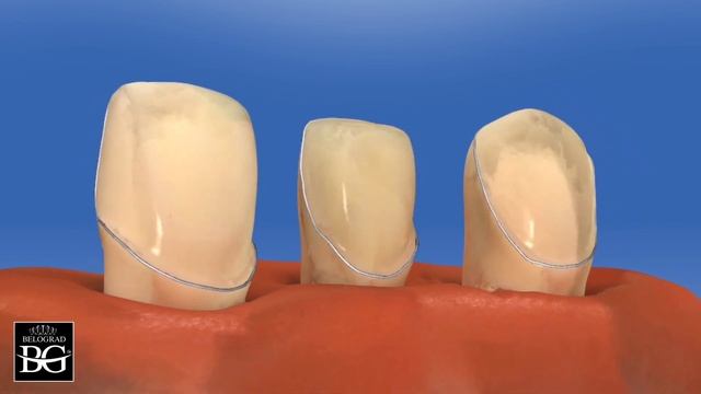 Три основных дизайна препарирования под виниры. Three different designs for veneer preparation смотреть онлайн